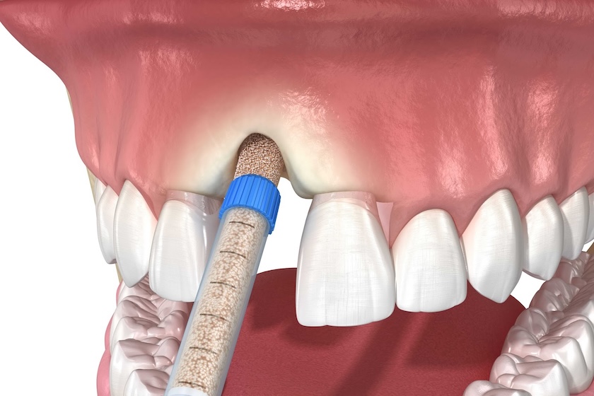 bone graft