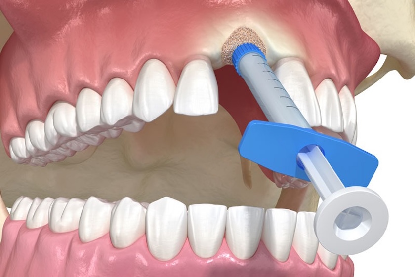 bone graft