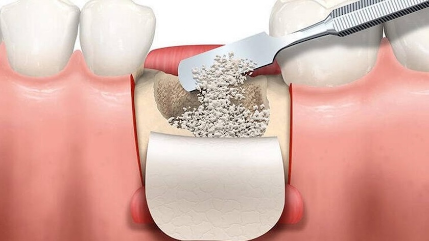 bone graft