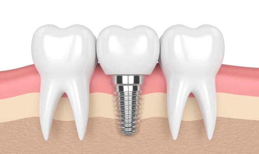dental implants