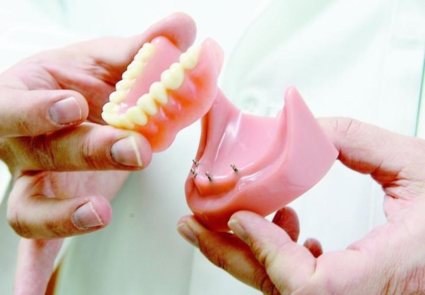mini implants
