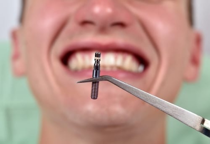 mini implants