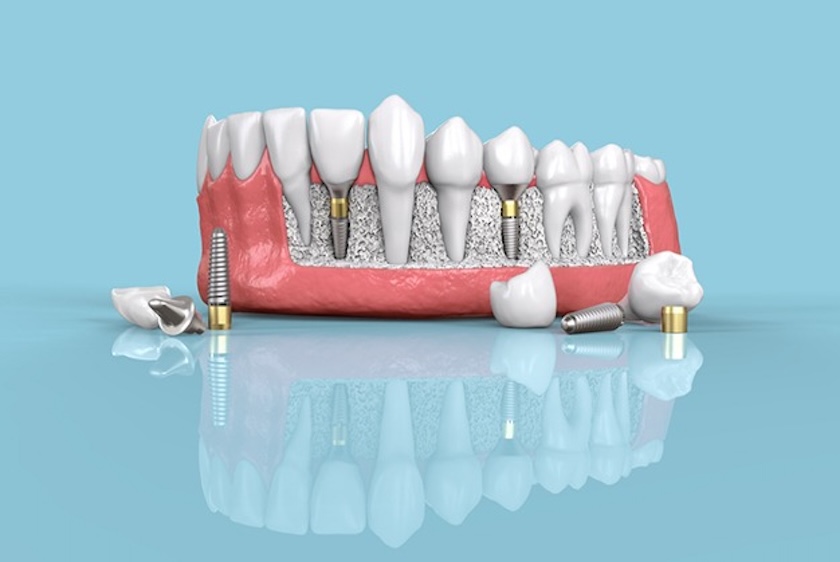 mini implants
