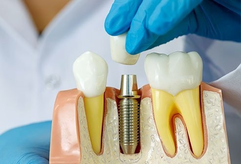 implants